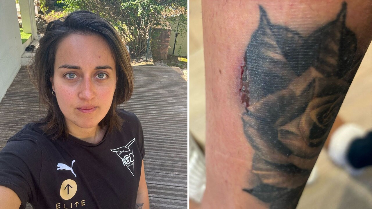 elle finit brûlée au second degré