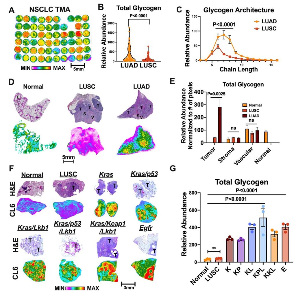 glycogene poumons cancer