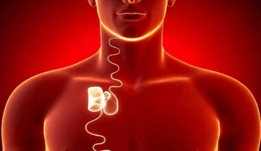 L'invention d'un implant pour traiter efficacement l'apnée du sommeil.