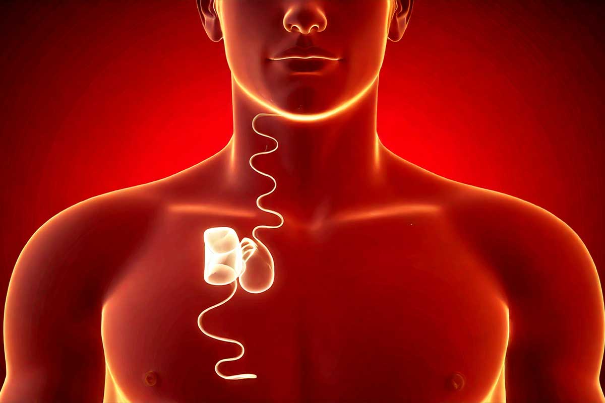 L'invention d'un implant pour traiter efficacement l'apnée du sommeil.