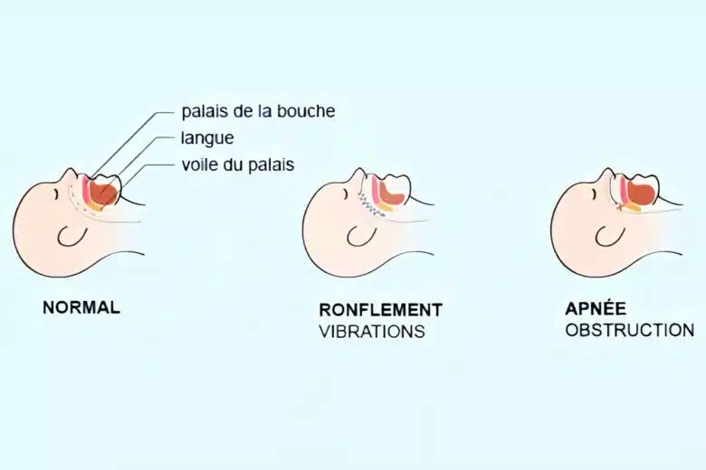Les mécanismes de l’apnée obstructive du sommeil.
