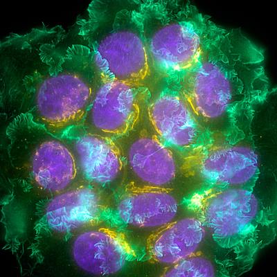 Le cancer de stade 0, un diagnostic peu courant qu'il faut connaître