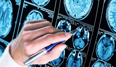 Les États-Unis approuvent le premier test sanguin de dépistage d'Alzheimer
