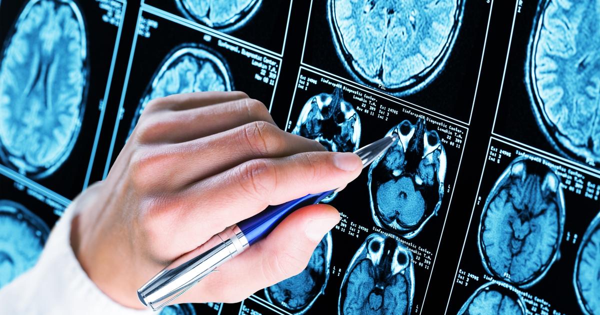 Les États-Unis approuvent le premier test sanguin de dépistage d'Alzheimer