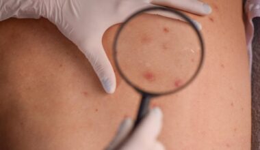 À 15 ans, il souffre d'un mélanome avancé, le médecin confond le premier signe de son cancer avec un symptôme de puberté