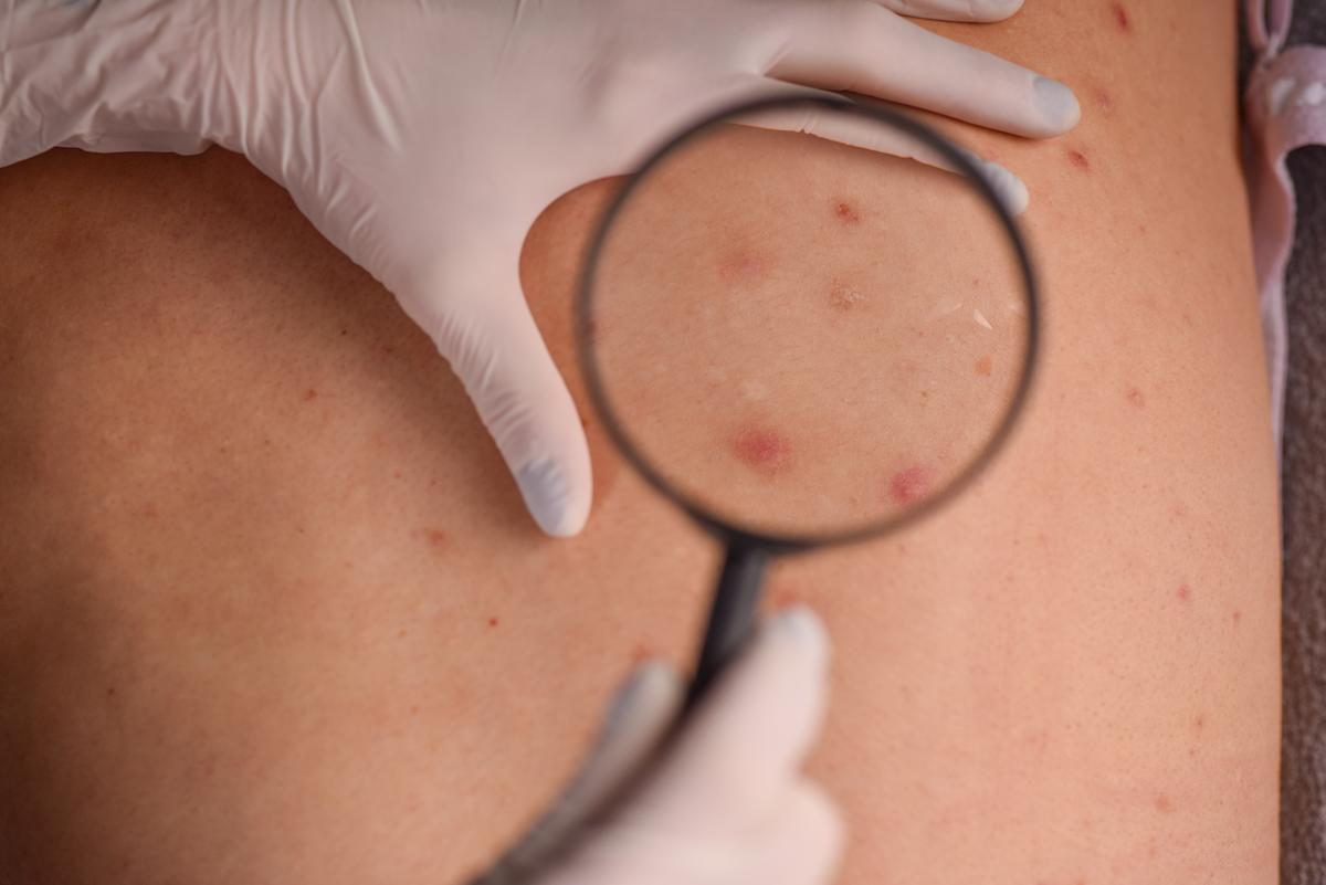 À 15 ans, il souffre d'un mélanome avancé, le médecin confond le premier signe de son cancer avec un symptôme de puberté