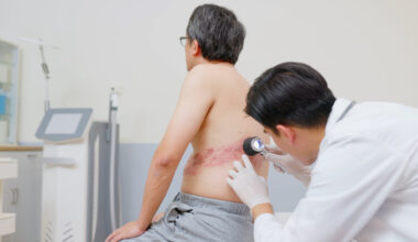 Pourquoi vacciner contre le zona chez le sujet âgé ?