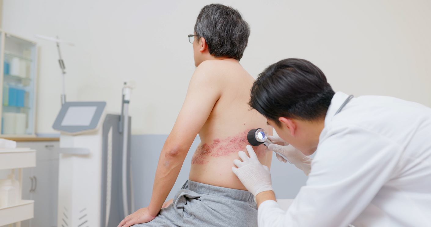 Pourquoi vacciner contre le zona chez le sujet âgé ?