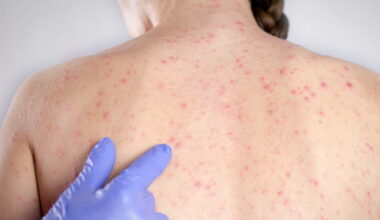 Haute-Savoie. Rougeole : deux clusters, 32 cas détectés mais « pas d’épidémie » - Le Dauphiné Libéré