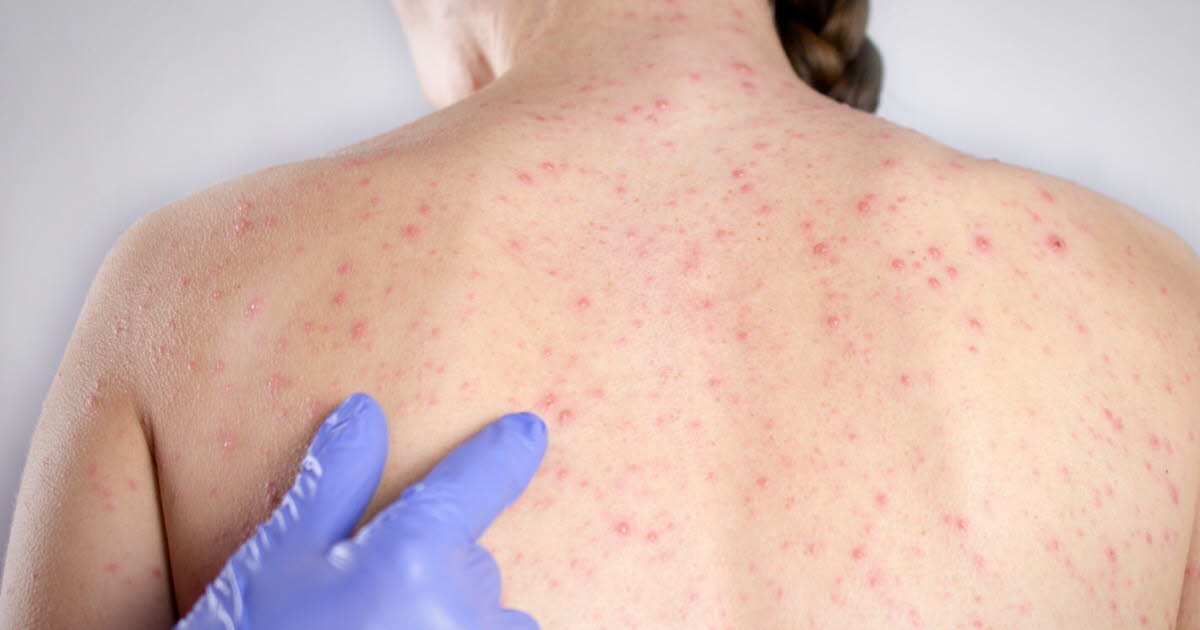 Haute-Savoie. Rougeole : deux clusters, 32 cas détectés mais « pas d’épidémie » - Le Dauphiné Libéré