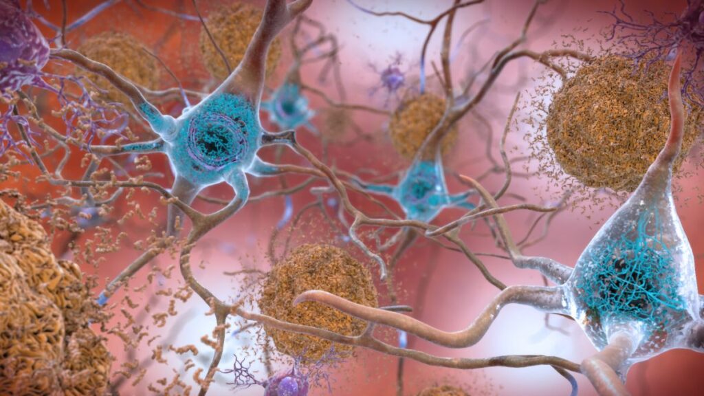 Alzheimer Herpes