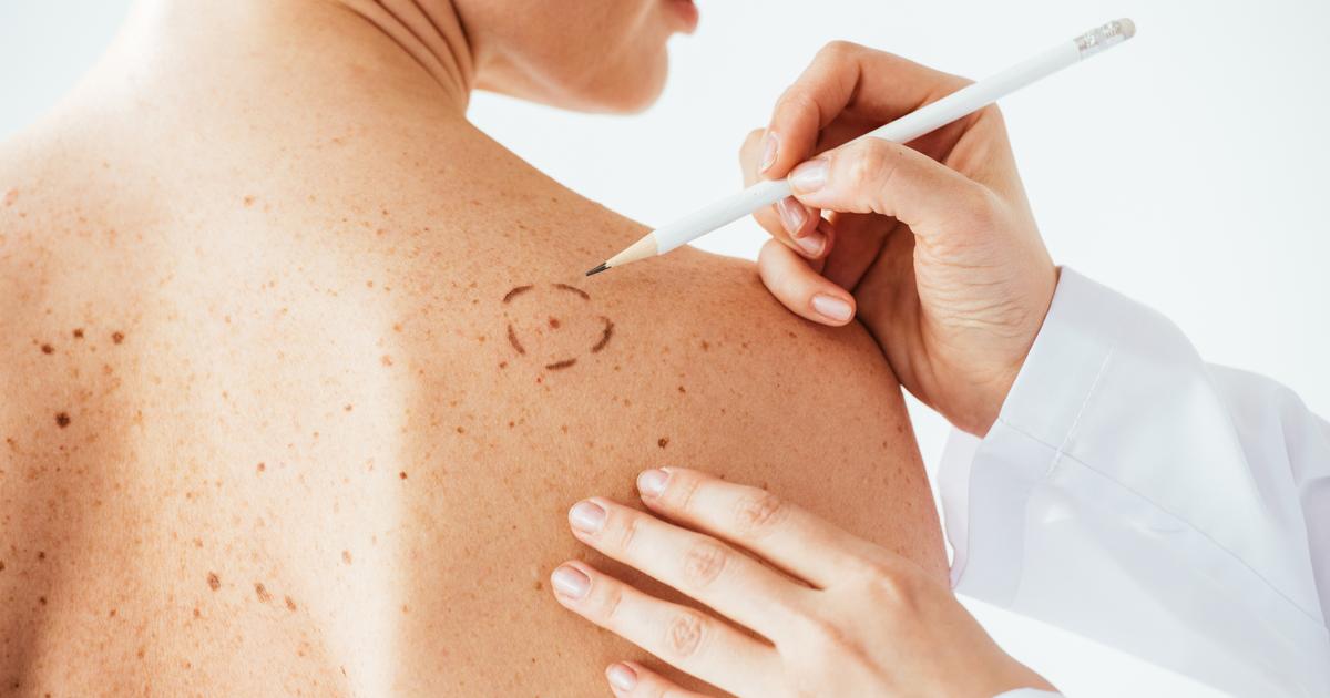 Les œstrogènes peuvent aggraver des cancers jusqu’ici considérés comme non liés aux hormones