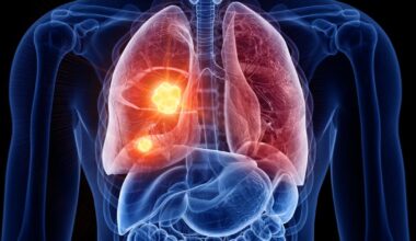 Et si les nouveaux traitements permettaient d’éviter la chirurgie contre les tumeurs pulmonaires ?