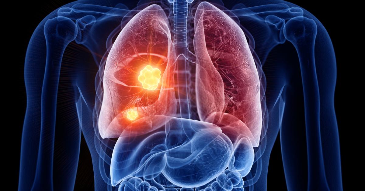 Et si les nouveaux traitements permettaient d’éviter la chirurgie contre les tumeurs pulmonaires ?