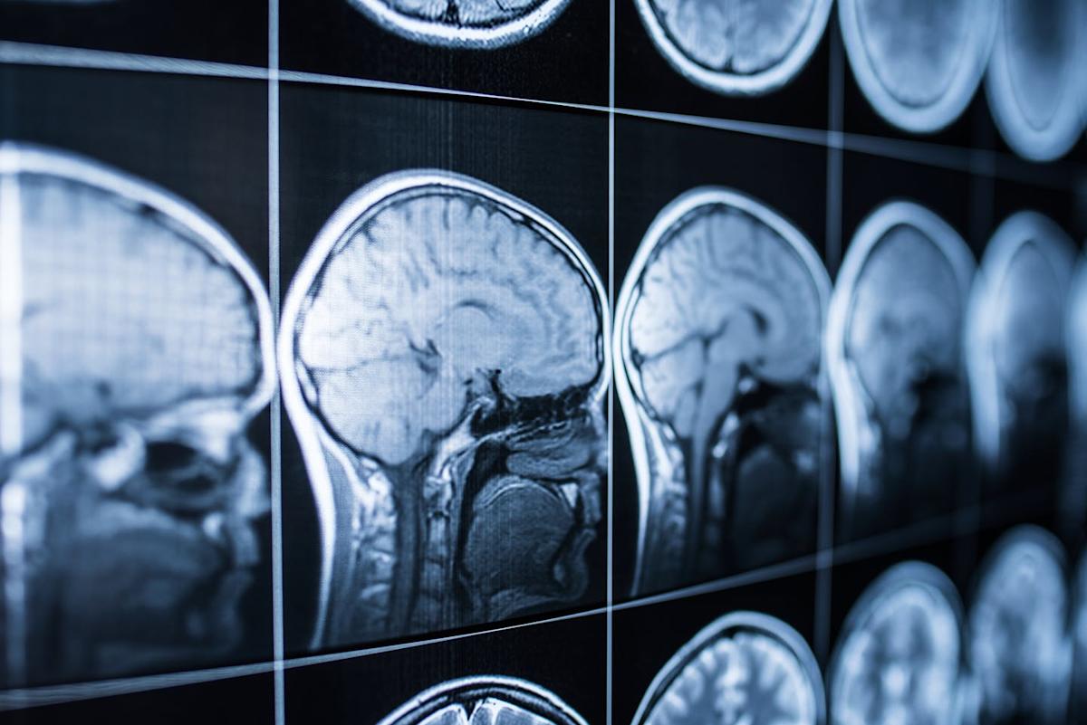 Selon une étude, et si le vieillissement du cerveau était une question de sucre ?