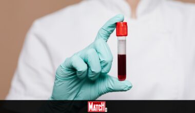 Si vous dépassez ce taux de cholestérol dans le sang, vous risquez de faire un AVC
