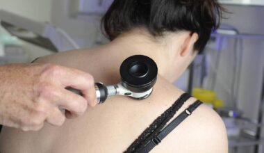 DIRECT VIDÉO. Cancer de la peau : posez vos questions, une oncologue vous répond en direct