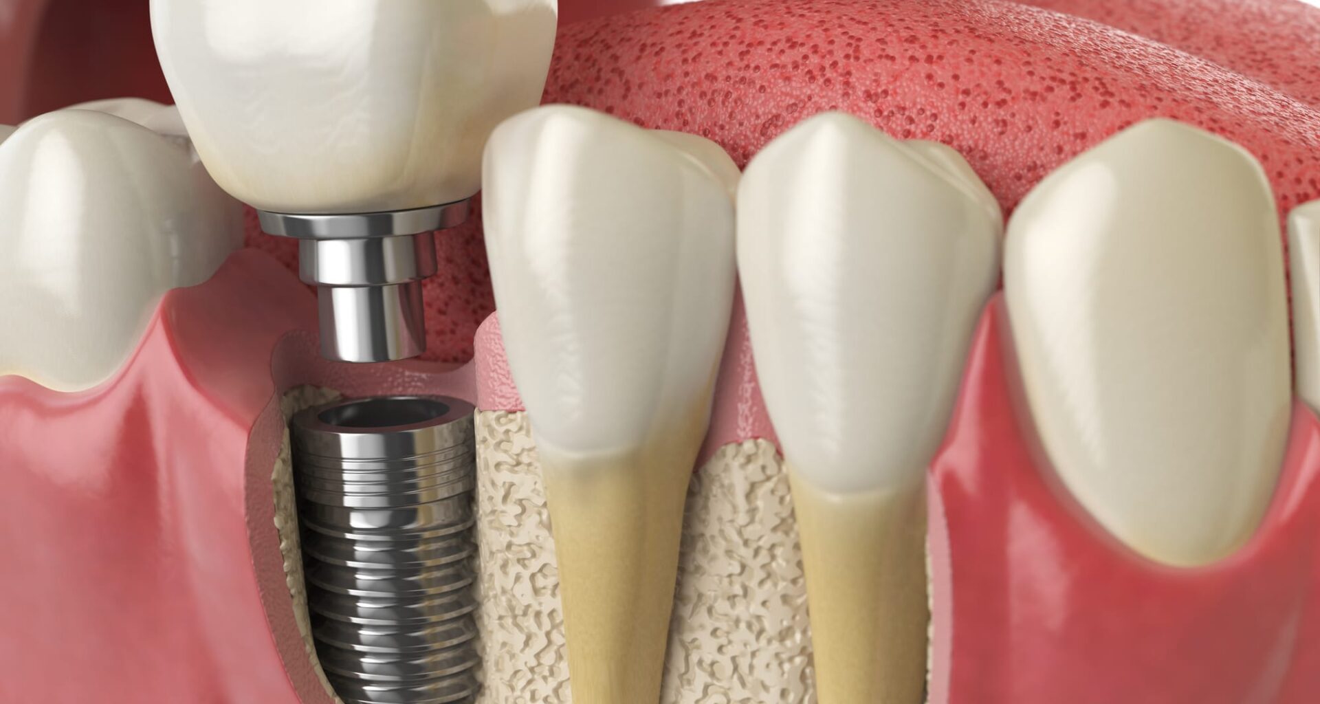 implants dentaires