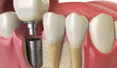implants dentaires