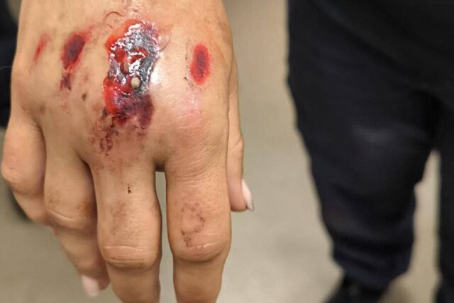 Parmi les trois policiers touchés, une fonctionnaire a été blessée à la main dans l’accident (© Alliance Police Nationale 31)