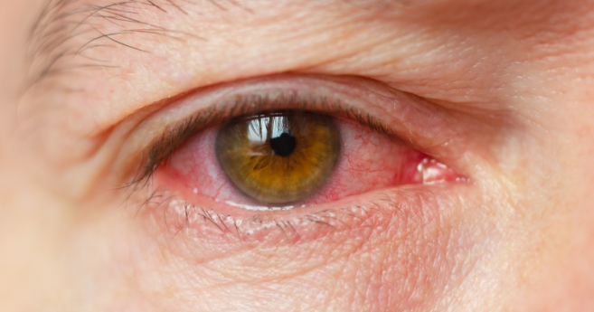 Une nouvelle routine validée par la science pour lutter contre la sécheresse oculaire