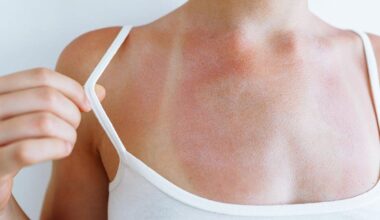 Après la tendance “anti-crème solaire”, la trend “Burn lines” est celle qui inquiète vivement les dermatologues