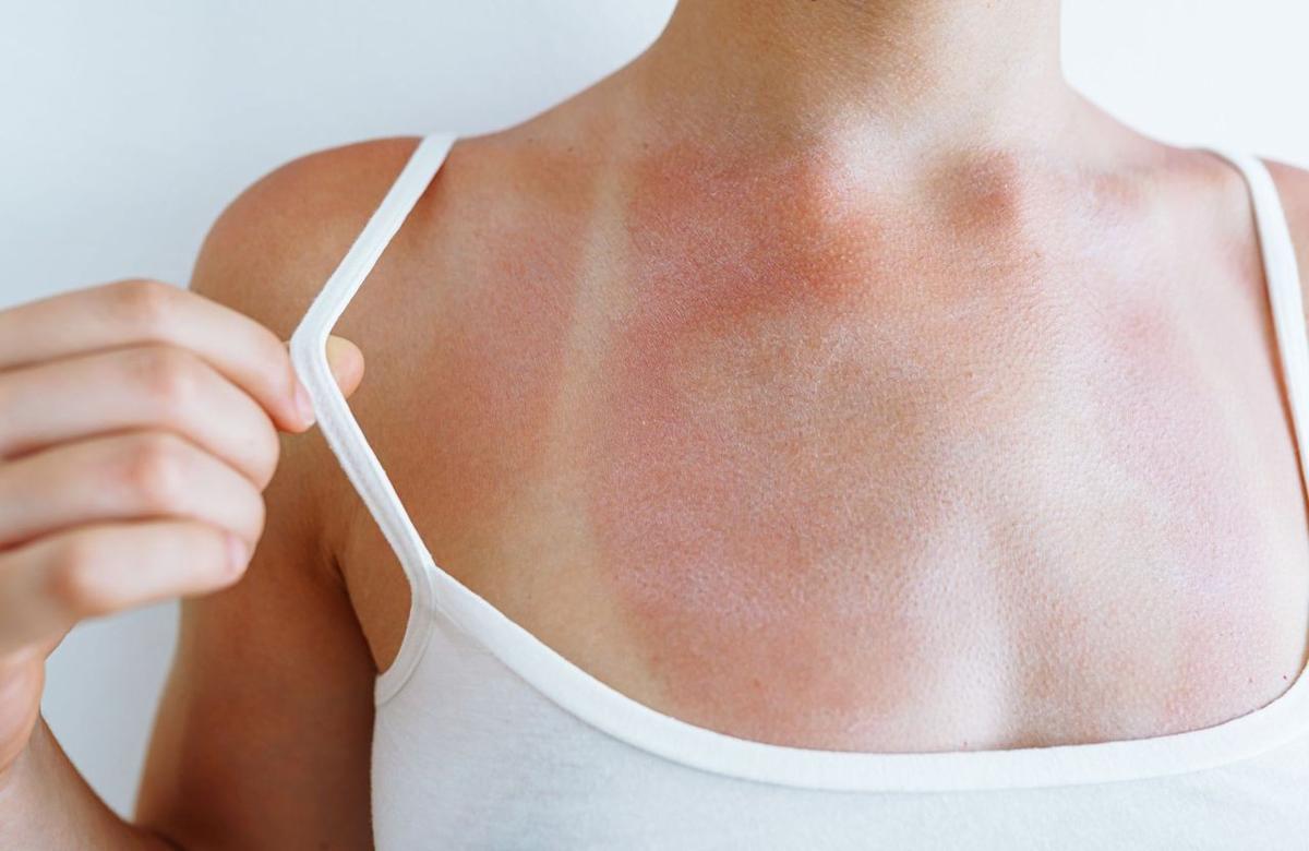 Après la tendance “anti-crème solaire”, la trend “Burn lines” est celle qui inquiète vivement les dermatologues