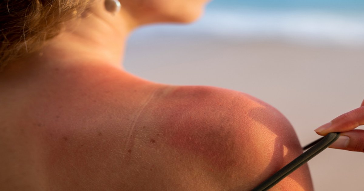 "Sun-tattoo", "burn-lines" … face aux tendances de bronzage, le ministre de la Santé exhorte les Français à se protéger du soleil : Actualités