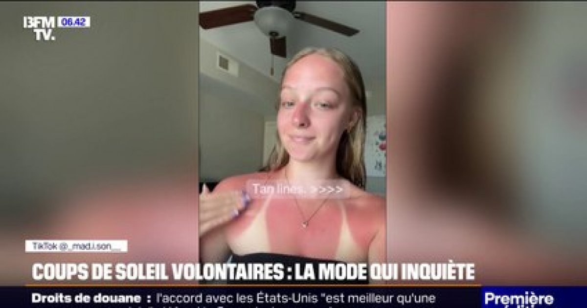 La tendance des "burn lines" inquiète les dermatologues - Actualités – Orange