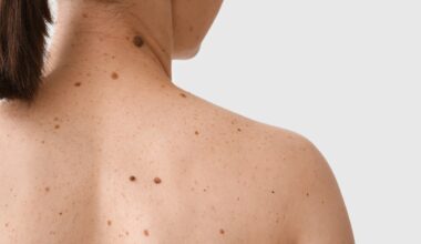 “Des dérives préoccupantes” dans le dépistage des cancers par IA : ce que redoutent vraiment les dermatologues