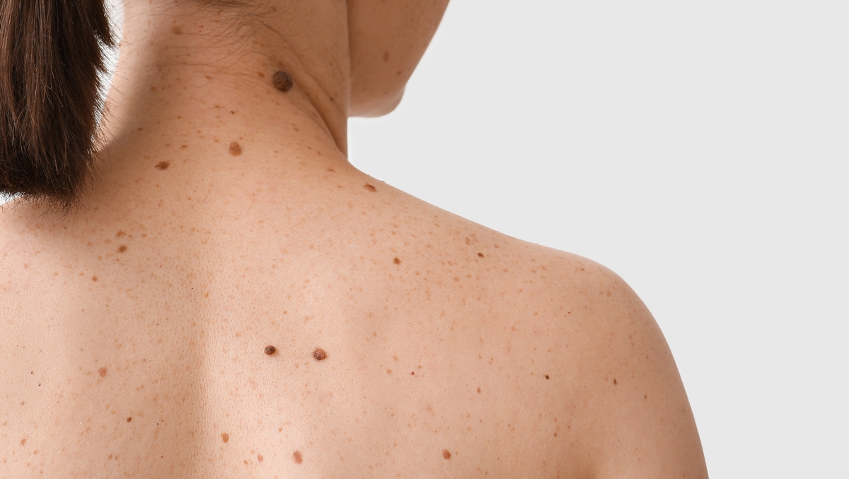“Des dérives préoccupantes” dans le dépistage des cancers par IA : ce que redoutent vraiment les dermatologues