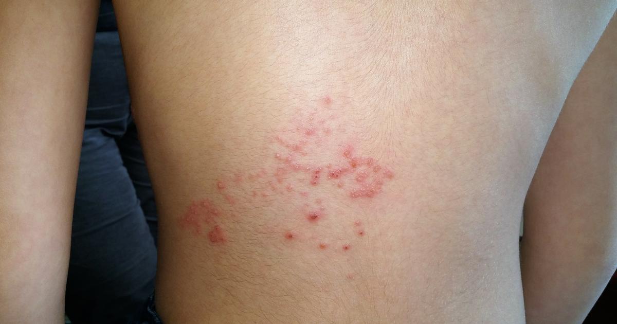Faut-il vraiment vacciner tous les plus de 65 ans contre le zona ?
