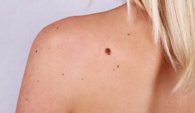 les dermatologues alertent sur « les dérives » du dépistage par IA