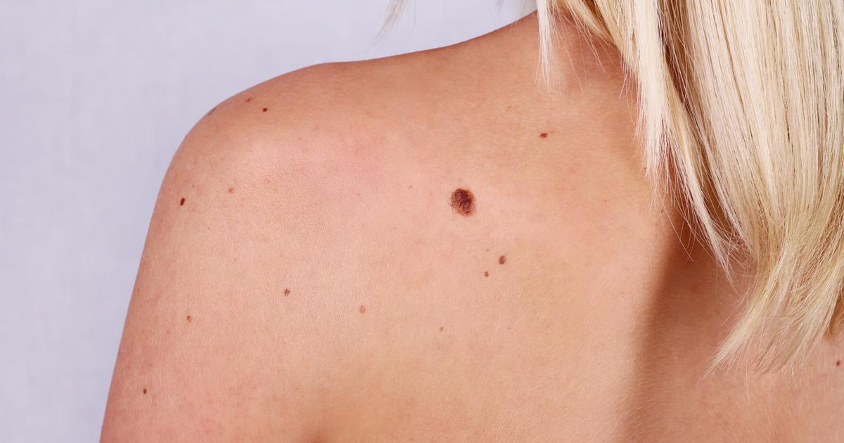 les dermatologues alertent sur « les dérives » du dépistage par IA