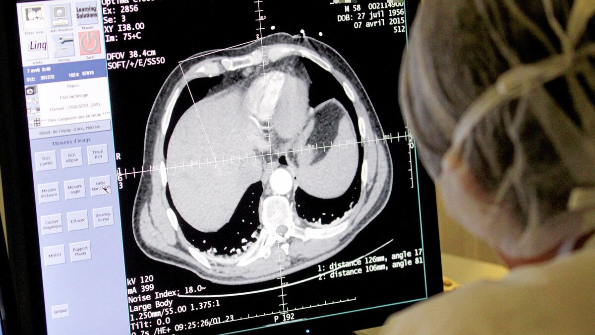 Cancer du foie : le nombre de cas pourrait doubler d’ici 2050, alors que la plupart sont évitables