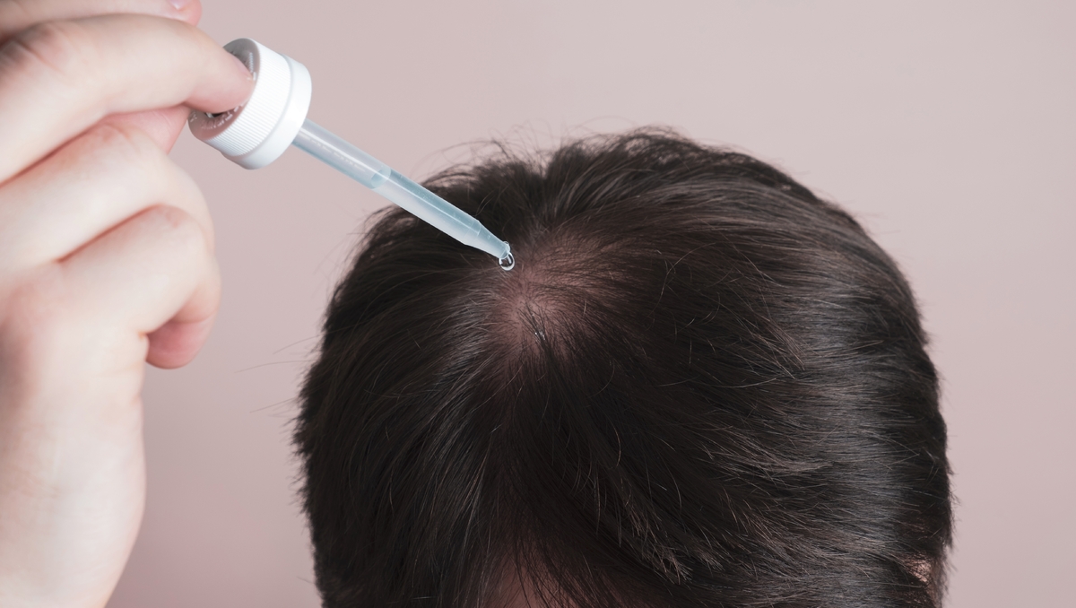 Calvitie – Un gel testé chez l’humain déclenche une vraie repousse : “Ce traitement a produit de vrais cheveux, pas du duvet”