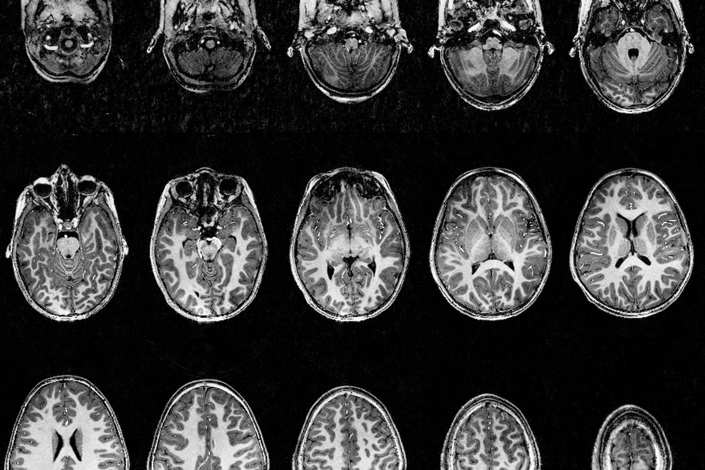 une nouvelle technique d’IRM permet d’obtenir des images d’une précision inédite