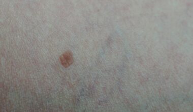 À 33 ans, elle pense s'être fait piquer par un moustique, les médecins lui diagnostiquent un cancer de la peau