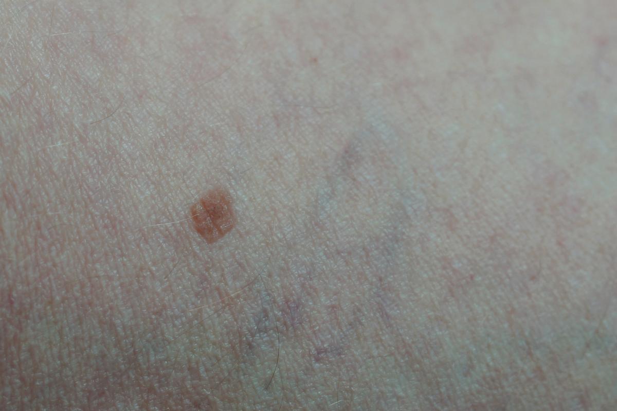 À 33 ans, elle pense s'être fait piquer par un moustique, les médecins lui diagnostiquent un cancer de la peau