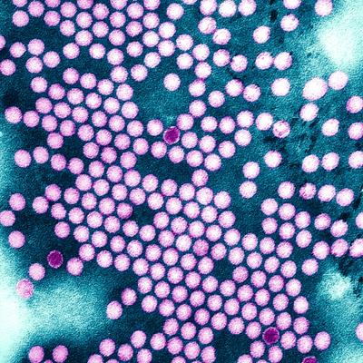 Pourquoi la polio est de retour