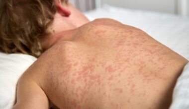 "Elle est dix fois plus transmissible que la grippe" : rougeole en forte hausse en Occitanie, les autorités lancent un appel urgent à la vaccination