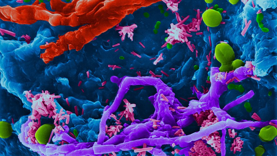 Qu’est-ce que le « syndrome d’auto-brasserie » ou comment notre microbiote peut-il se transformer en microbrasserie ?