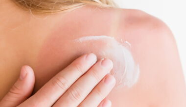 Le yaourt est-il vraiment un remède miracle pour les coups de soleil ? Ce médecin est formel