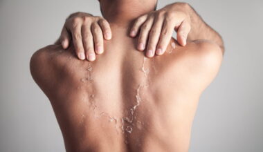 voici les conseils d'une dermatologue si la peau pèle après un coup de soleil