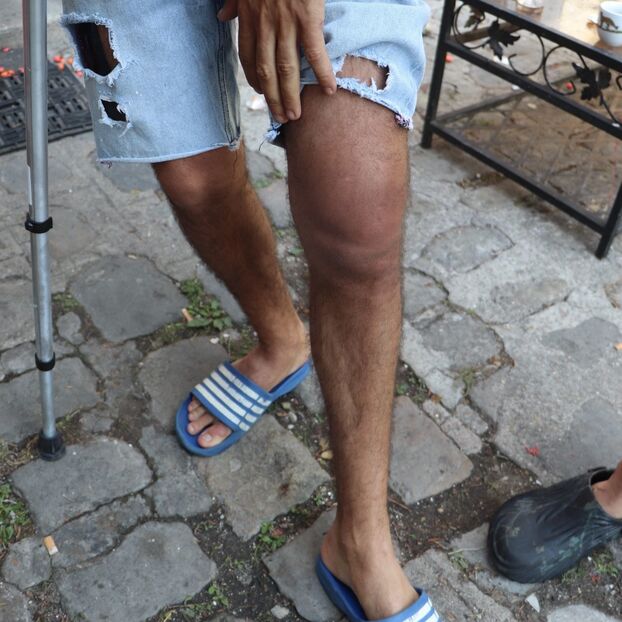 Le genoux gonflé de l'une des victimes de l'attaque de Montreuil dans la nuit du 14 au 15 août. LP/Sofia Goudjil