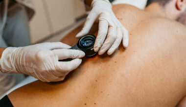 Traitements, vaccins… Les espoirs fous de la recherche contre le cancer de la peau