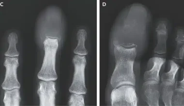 doigt gonflé cancer