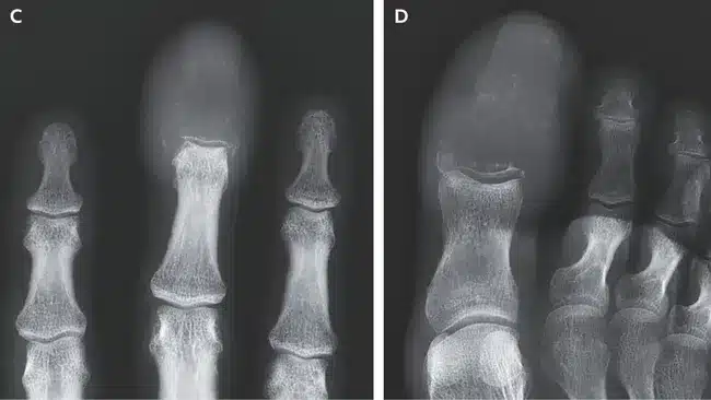 doigt gonflé cancer