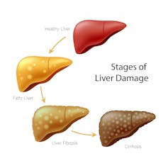 Diagramme représentant la dégradation du foie, du foie sain à la stéatose, puis à la fibrose et enfin à la cirrhose