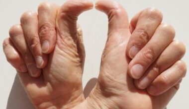 Trop souples pour être en bonne santé ? Les hyperlaxes sont plus sujets à des problèmes chroniques